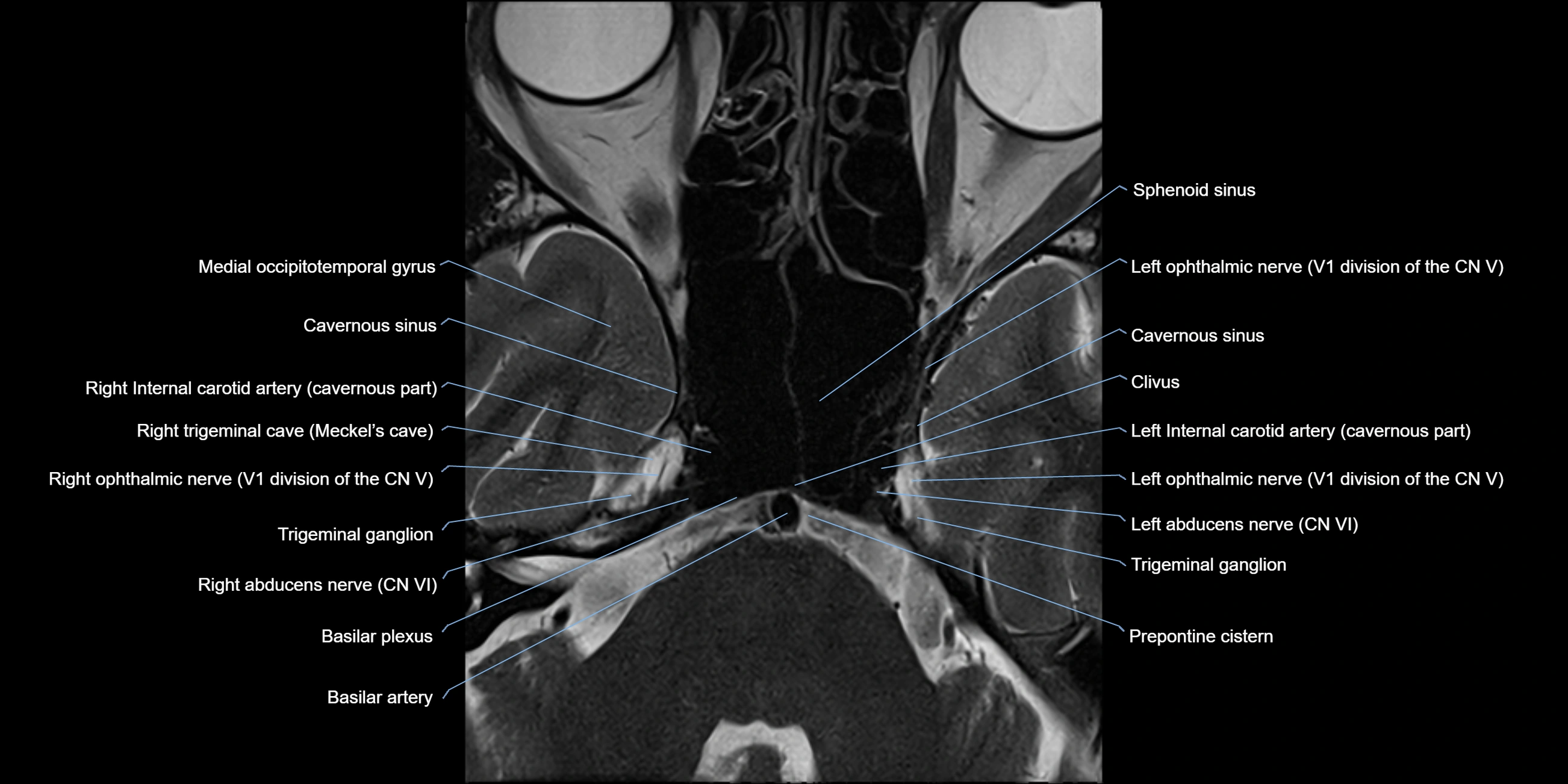 MRI cavernous sinus axial cross sectional 3T anatomy image-img-11001-00007.webp
